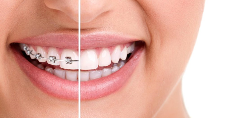Diş Teli Hakkında Bilinmesi Gereken Noktalar